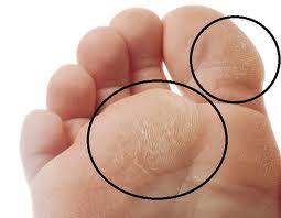 calluses on foot