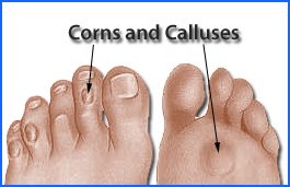 differences between calluses and corns, corns and calluses