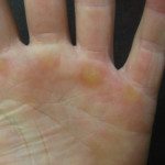How To Stop Calluses on Hands Coming Back Tricks And Tips