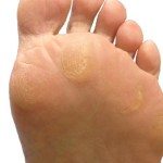 Callus on The Bottom Of The Foot: What Are They & How To Prevent One