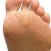 Plantar callus at the base of the foot